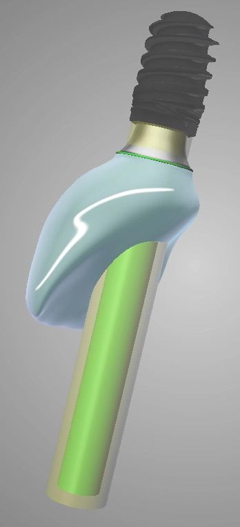 Abb. 17: Virtuelles Design der Implantatkrone.