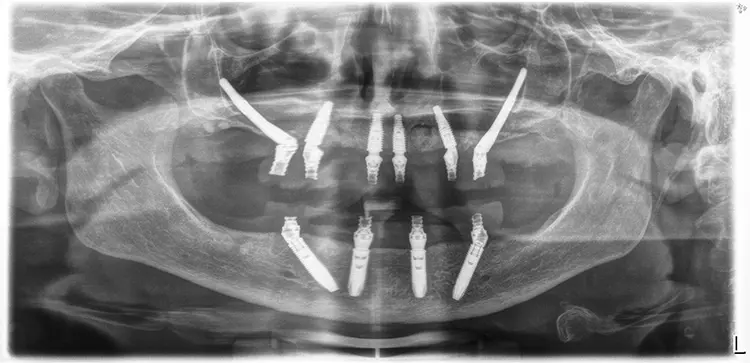 Abb. 18: OPG mit 8 Standard und 2 Zygoma-Implantaten.