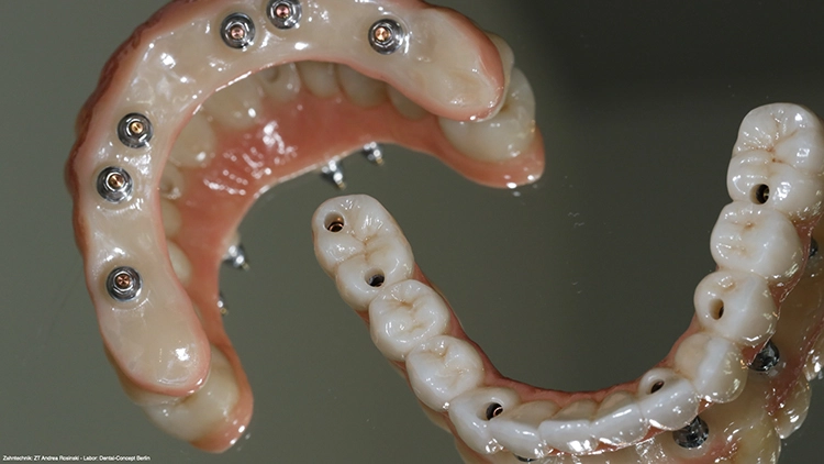 Abb. 18: Finale vollkeramische Suprastrukturen (Zahntechnik: ZT Andrea Rosinski, Dental Concept-Berlin GmbH).