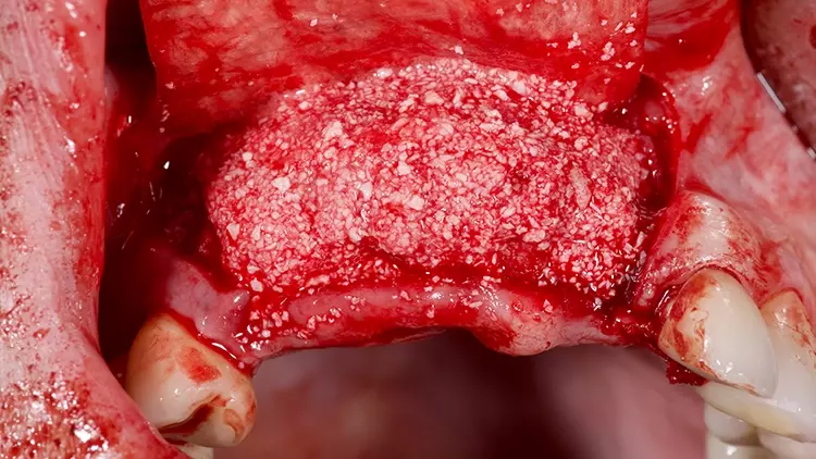 Abb. 18: Im Defekt platzierter Sticky-Bone aus L-PRF, autologem Knochen und
einem bovinen Ersatzmaterial MinorOssX, Fa. BioHorizons).