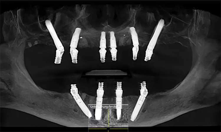 Abb. 19: Ansicht im DVT mit korrekter Darstellung der Implantat Achsen.