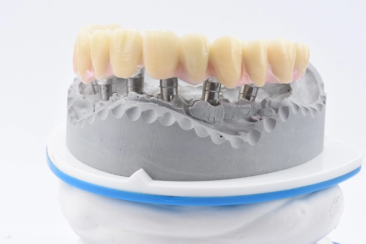 Abb. 19: Wax-up auf dem Gerüst.