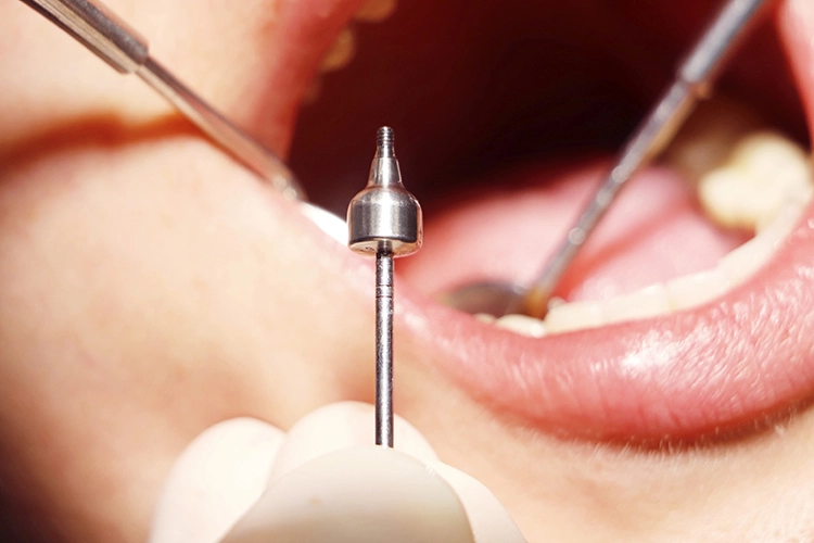 Abb. 19: Gingivaformer mit 6,5 mm Durchmesser.