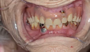 Intraorale Situation einer 100-jährigen Studienteilnehmerin mit 5 Implantaten (4 im Oberkiefer, 1 im Unterkiefer). Im Oberkiefer trägt die Patientin eine implantatgetragene Totalprothese, im Unterkiefer eine implantat- und zahngetragene Teleskoparbeit.