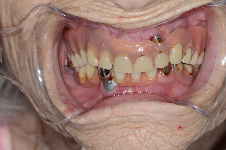 Abb. 1a u. b: Intraorale Situation einer 100-jährigen Studienteilnehmerin mit 5 Implantaten (4 im Oberkiefer, 1 im Unterkiefer). Im Oberkiefer trägt die Patientin eine implantatgetragene Totalprothese, im Unterkiefer eine implantat- und zahngetragene Teleskoparbeit. 2 der untersuchten Implantate waren frei von periimplantären Veränderungen, 2 wiesen eine periimplantäre Mukositis auf und 1 Implantat eine Periimplantitis.