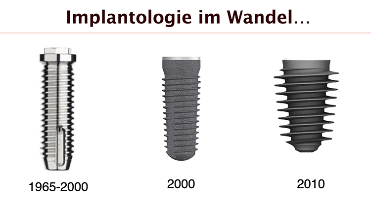 Abb. 1: Die Entwicklung der Implantatdesigns.