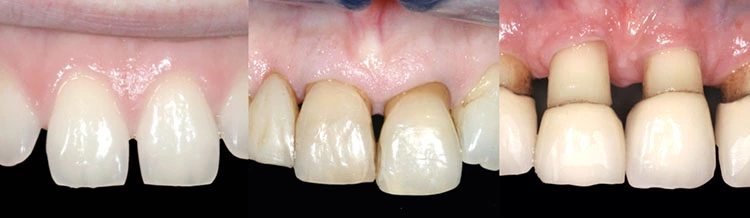 Abb. 1: Die Ausfüllung und Erscheinung der Papille ist abhängig von diversen Faktoren. Vor allem der Gingivamorphotyp, der Interdentalabstand, die Lage des Alveolarknochens und des Kontaktpunktes sind wichtige Faktoren für die Ausformung.