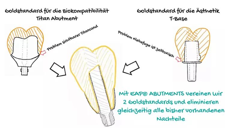 Abb. 1: Skizze Gold-Standards und EAP® Abutments.