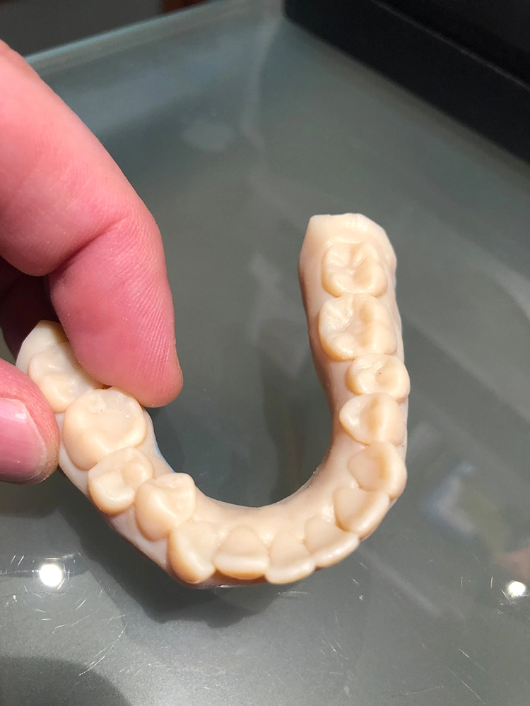 Abb. 1 und 2: 3D-Drucktechnologie zur vorausschauenden Darstellung und Patientenaufklärung vor und nach
einer KFO-Behandlung.