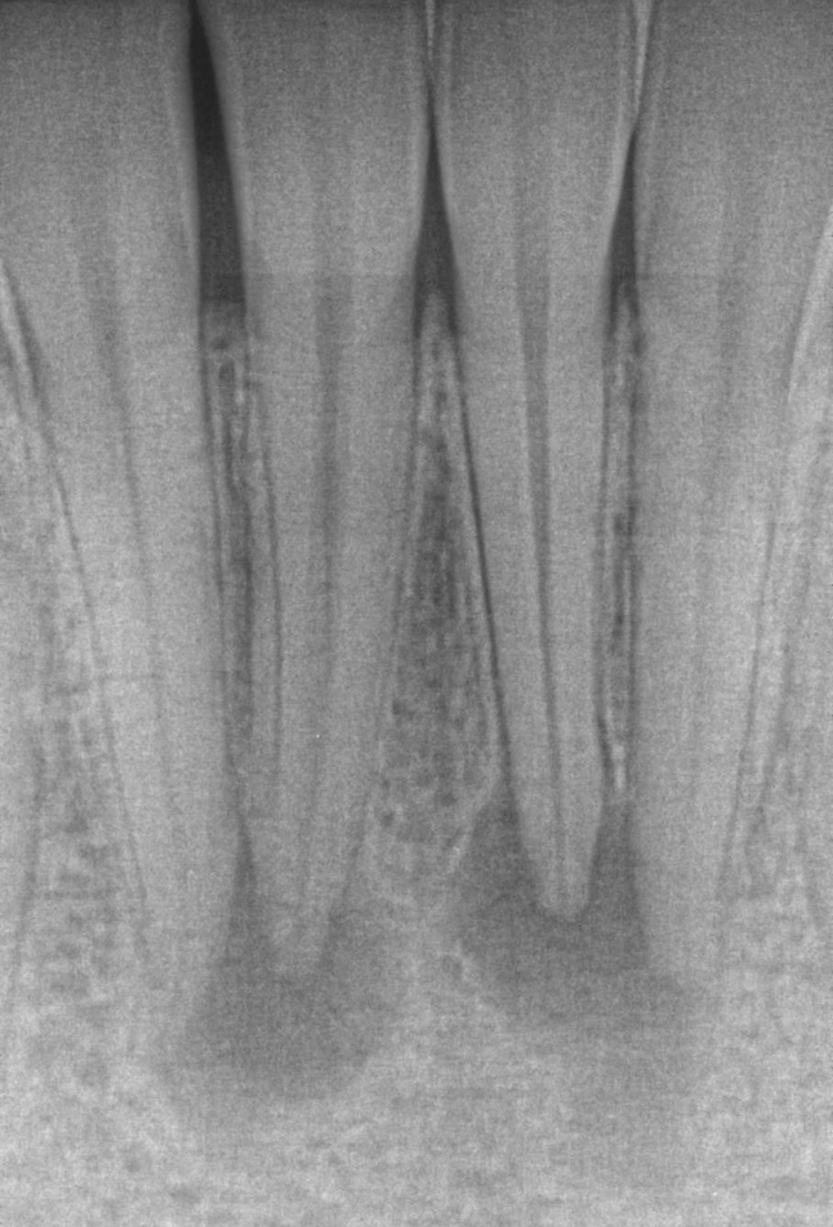 Abb. 2: Zahnfilmaufnahme der Unterkieferfront mit periapikalen Osteolysen ausgehend von den Zähnen 31/41.