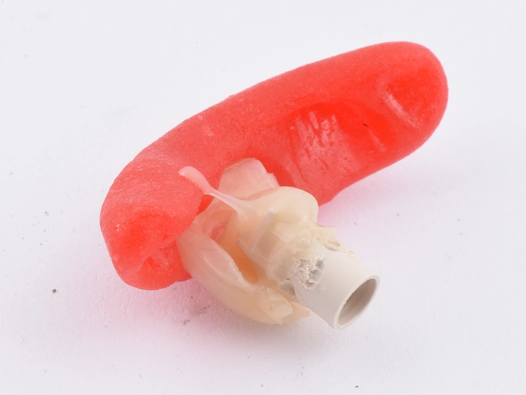 Abb. 20: Verklebung des Provisoriums mit dem Abutment.