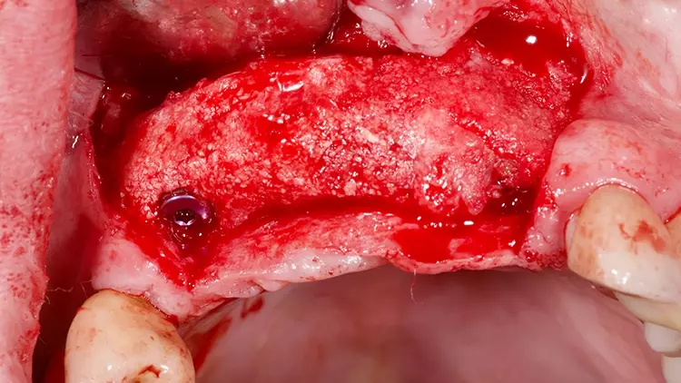 Abb. 20: Implantatinsertion vier Monate nach der Augmentation.