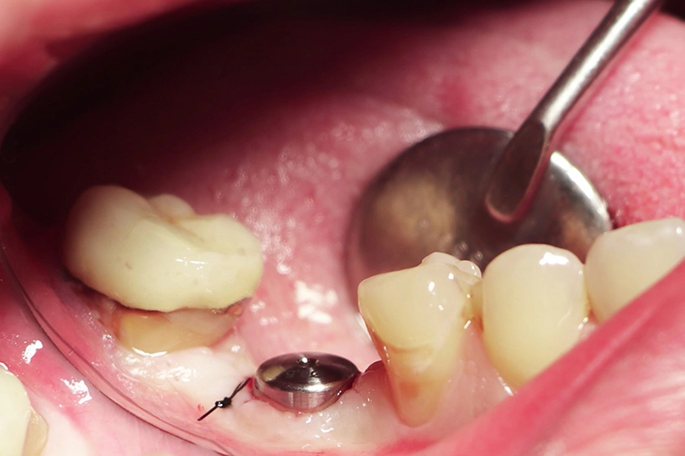 Abb. 20: Gingivaformer 6,5 mm in situ.