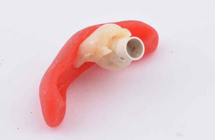 Abb. 21: Verklebung des Provisoriums mit dem Abutment.