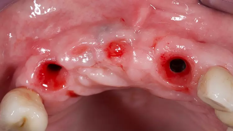 Abb. 22: Klinisches Ergebnis vier Monate nach der Implantation.