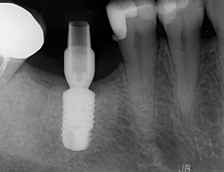 Abb. 22: Röntgenkontrolle vor Implantatabformung.
