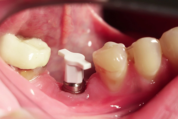Abb. 23: Abformpfosten mit Kunststoffkäppchen für geschlossene Implantatabformung.