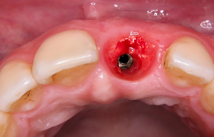 Abb. 23: Entfernung des Gingivaformers, gingivale Verhältnisse 20 Stunden postoperativ.