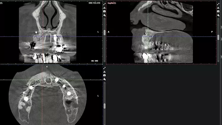 Abb. 23: Postoperatives DVT mit sichtbarer Volumenstabilität des Augmentats.