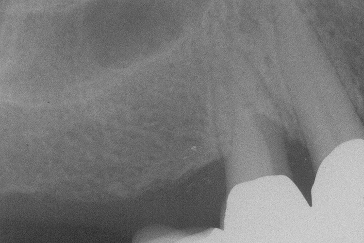Abb. 23a: Rö-Status (23h Endorevision)