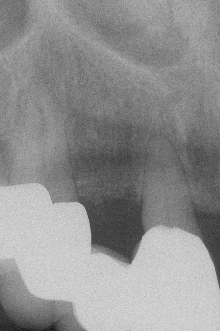 Abb. 23b: Rö-Status (23h Endorevision)