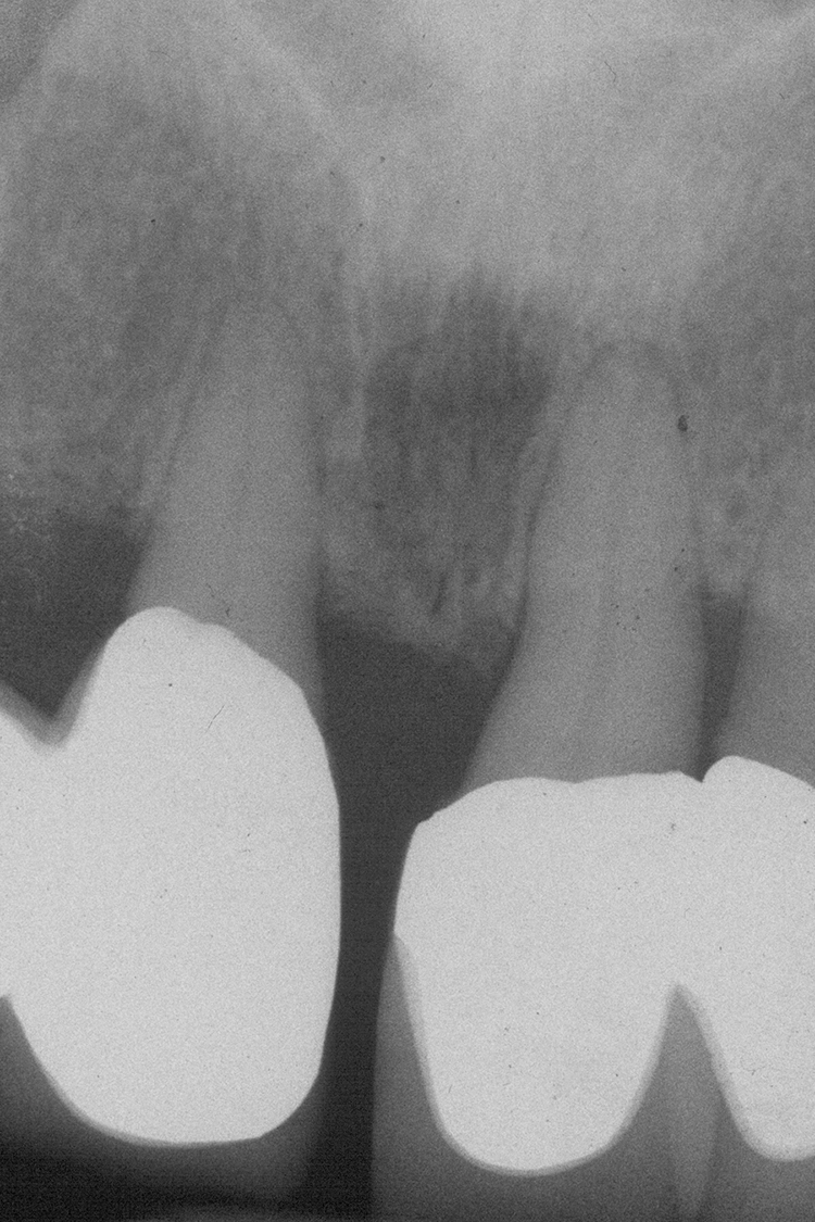 Abb. 23c: Rö-Status (23h Endorevision)