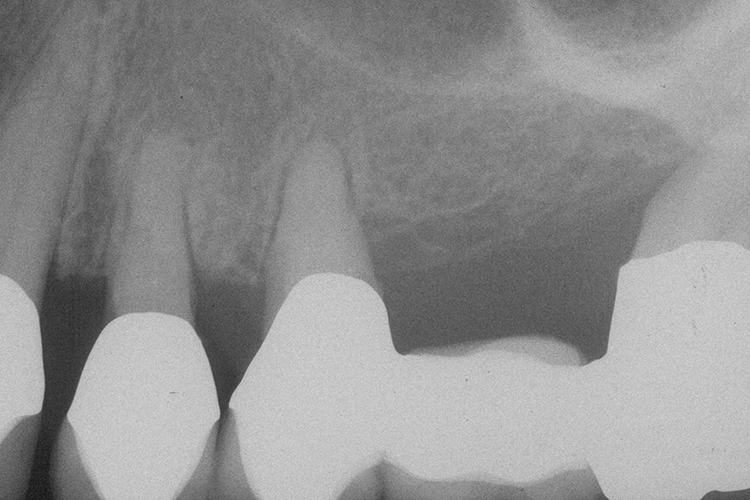 Abb. 23e: Rö-Status (23h Endorevision)