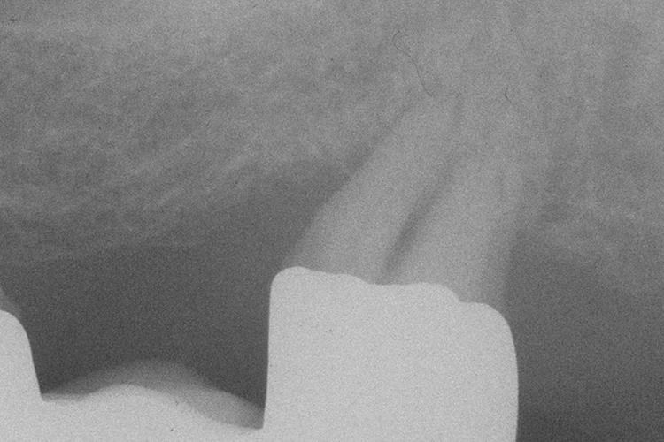 Abb. 23f: Rö-Status (23h Endorevision)