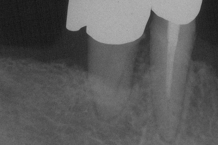 Abb. 23g: Rö-Status (23h Endorevision)
