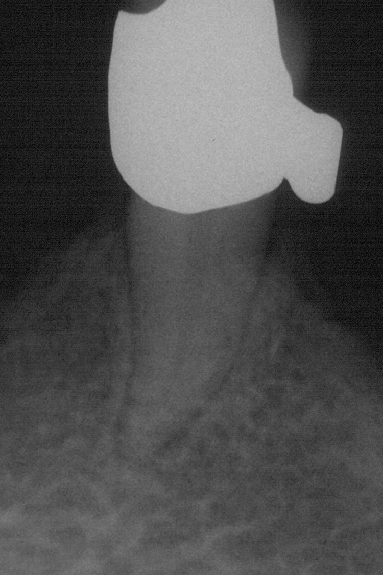 Abb. 23i: Rö-Status (23h Endorevision)