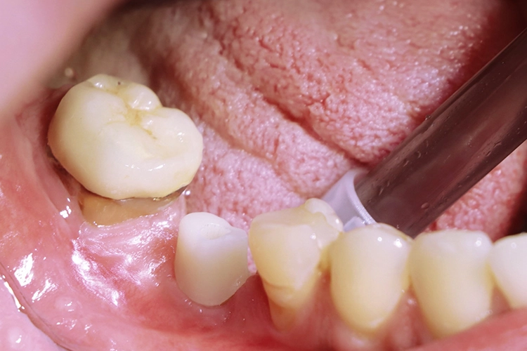 Abb. 24: Individuelles Hybrid-Abutment 46.