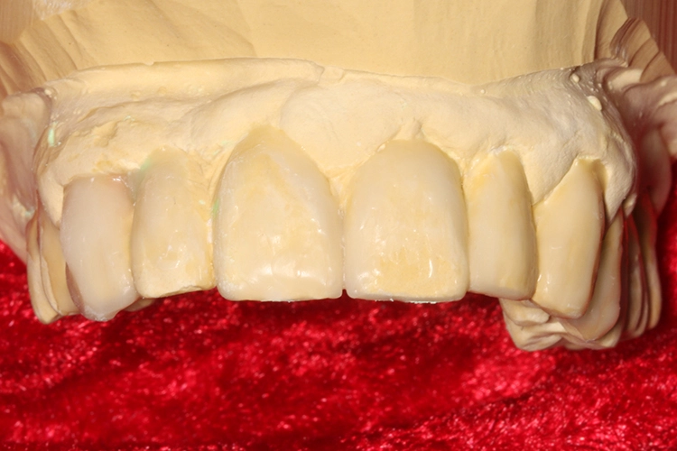 Abb. 26: Wax-up.