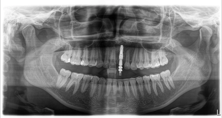 Abb. 27: Radiologische Kontrolle des präzisen Sitzes des Abformpfostens auf dem Implantat.