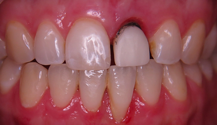 Abb. 28: Keramikgerüst mit bleistiftgezeichnetem Gingivaverlauf im Mund.