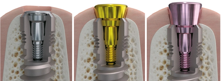 Abb. 2: Eine Georgi-Hybridschraube schließt idealerweise 1-2 mm subgingival. Sie ist in drei Gingivahöhen verfügbar (0,5 / 1,5 / 2,5 mm).