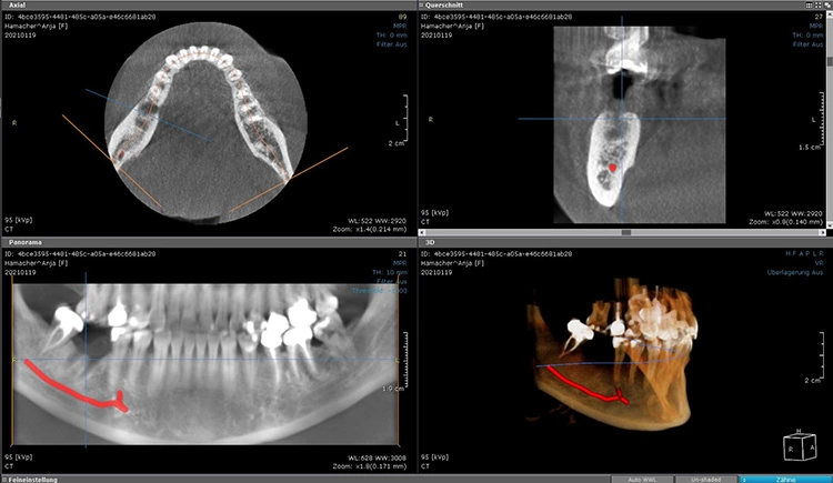 Abb. 2: Digitale Volumentomographie (DVT). Rot markiert ist der Verlauf des N. alveolaris inferior.