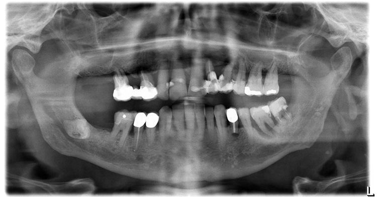Abb: 2: Radiologischer Ausgangsbefund.