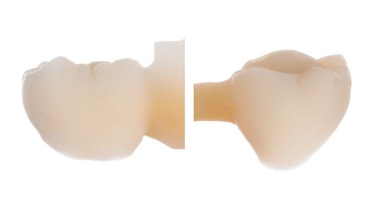 Abb. 2: Der zahnähnliche Aufbau von IPS e.max Press Multi erlaubt es, den Schmelz- und Dentinanteil der Restauration fallspezifisch zu steuern.