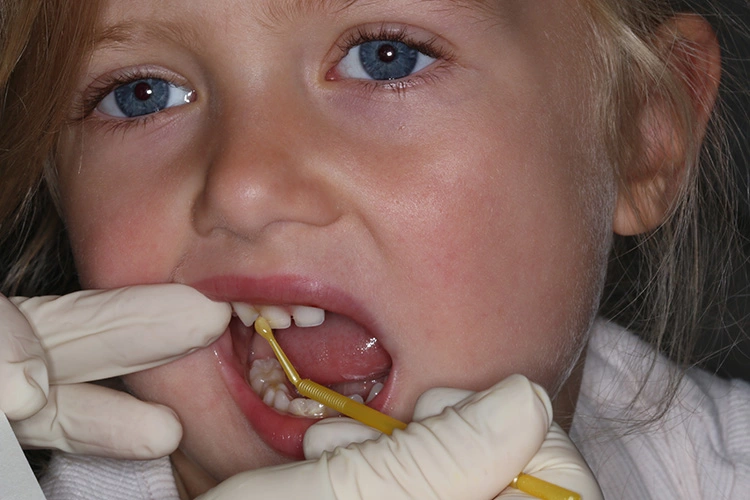 Abb. 2: Lokale Fluoridlackapplikation bei einem Kleinkind.
