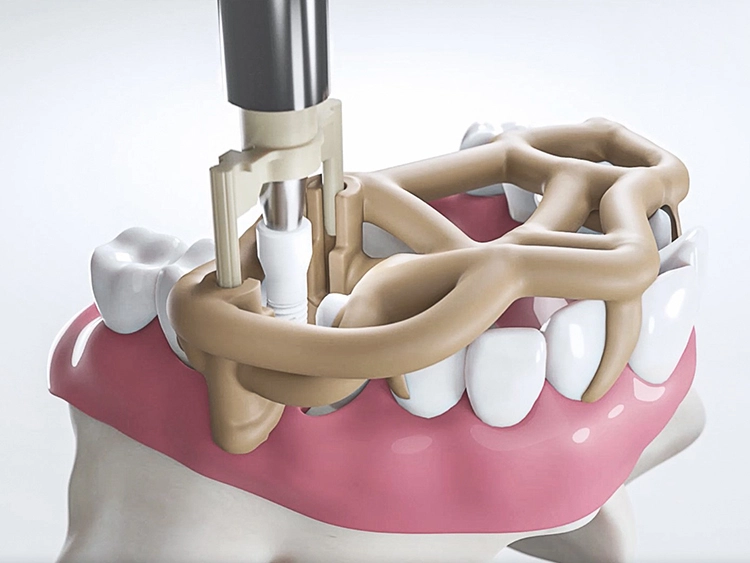 Abb. 2: Das neue, schienenbasierte Navigationssystem SDS BOX FULL NAVIGATION SYSTEM wird mit dem „Approved by CleanImplant“-Logo für rückstandsfreie Implantologie ausgezeichnet und wird somit das erste dentale Navigationssystem mit dem begehrten Prüfsiegel auf dem Markt sein. Auch hierbei sind alle Komponenten aus reiner Zirkonoxidkeramik und so konzipiert, dass keine Verunreinigung
des Knochenlagers während der Implantation mit den SDS Implantaten entstehen können.