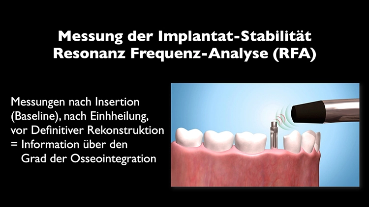 Abb. 2a: Die ISQ-Messung zur Bestimmung der Stabilität.