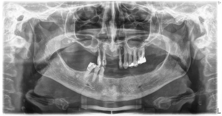 Abb. 3: OPG prä OP, beidseits deutlich ausgeprägte Sinus maxillaris.