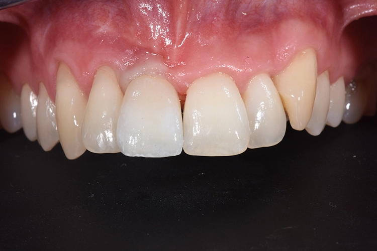 Eingliederung der Implantatkrone – vestibulär.