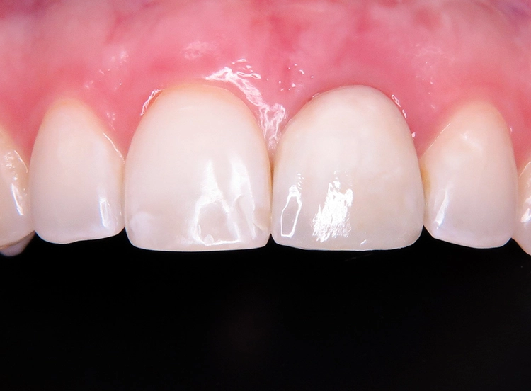 Abb. 30 a und b: Vollkeramische Implantatkrone im Mund verschraubt (zahntechnische Umsetzung: Dentallabor Lutz Tamaschke, Berlin).