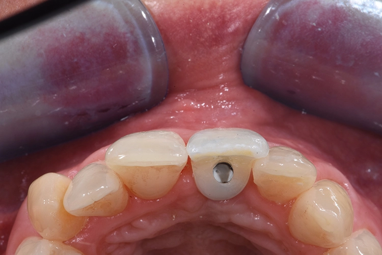 Abb. 31: Eingliederung der Implantatkrone – okklusal.