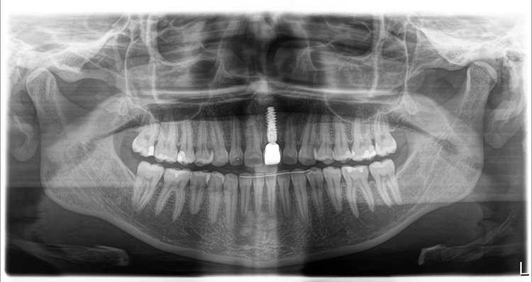 Abb. 31 a und b: Röntgenkontrolle nach Eingliederung der Implantatkrone.