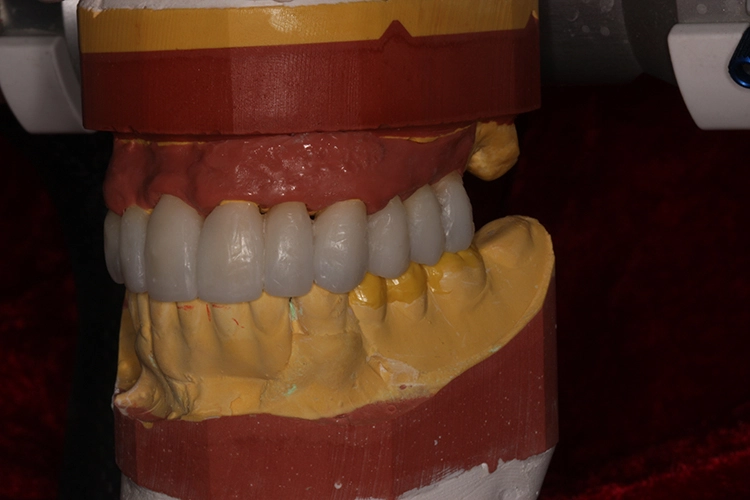 Abb. 33: Hygienefähige Zahntechnik.