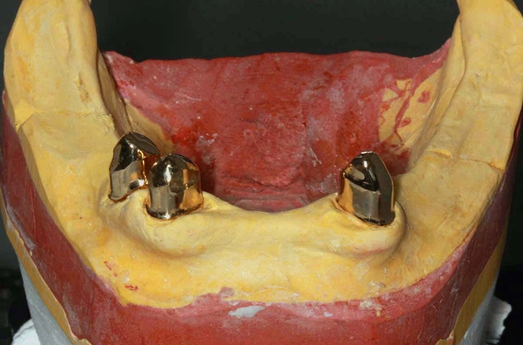 Abb. 35: Hygienefähige Zahntechnik.