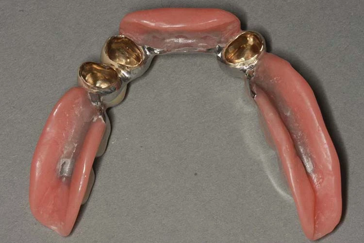 Abb. 36: Hygienefähige Zahntechnik.