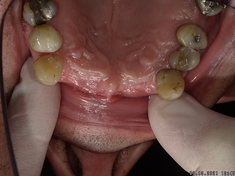 Abb. 3: Ausgangssituation vor Bone Split und Implantation vor Freilegung.